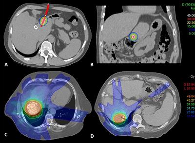 HDR Brachytherapy and SBRT as Bridging Therapy to Liver Transplantation in HCC Patients: A Single-Center Experience